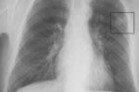 thorax